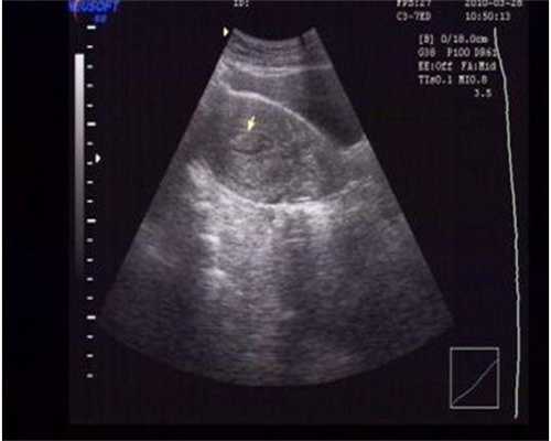 深圳子宫畸形供卵代怀价位（子宫偏小是什么原因）