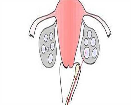 镇江试管用供卵条件，试管供卵要多少费用